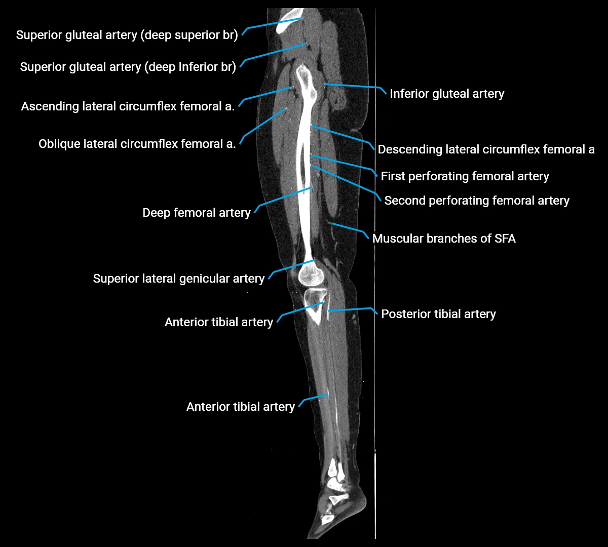 CTA lower limb sagittal cross sectional anatomy labelled image _50 (3).webp